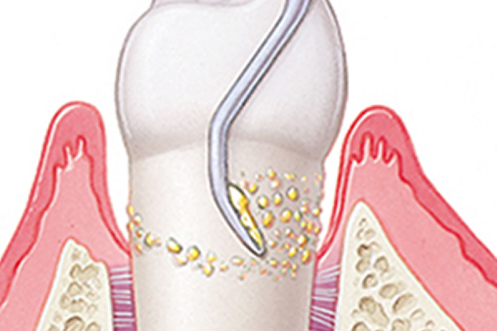 歯周病外科治療
